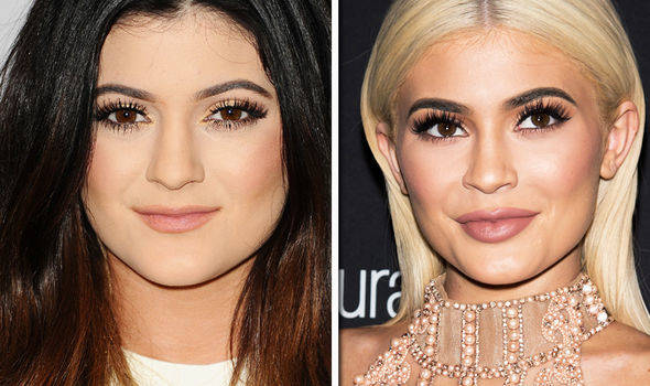 celebrities-post-bisturi-radical Kylie-Jenner 