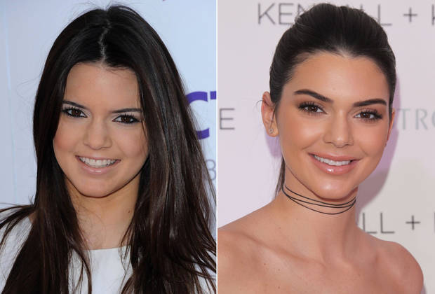 kendall-jenner post bisturí