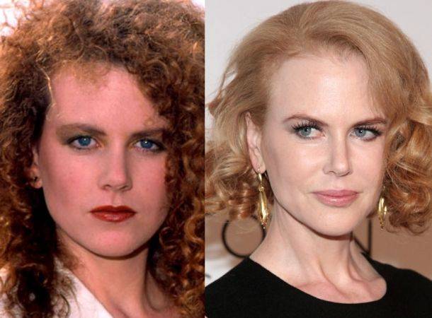 celebrities-post-bisturi-radical nicole-kidman